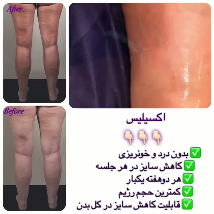 پکیج لاغری کاتالیز ر؛ اکسیلیس، ایکس ویو و مزوتراپی