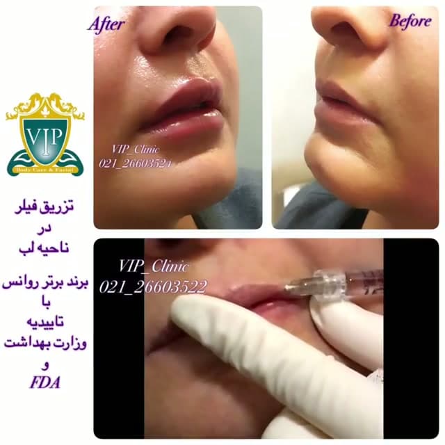 تزریق ۱ سی سی فیلر ریونس لب؛ ساخت کانادا