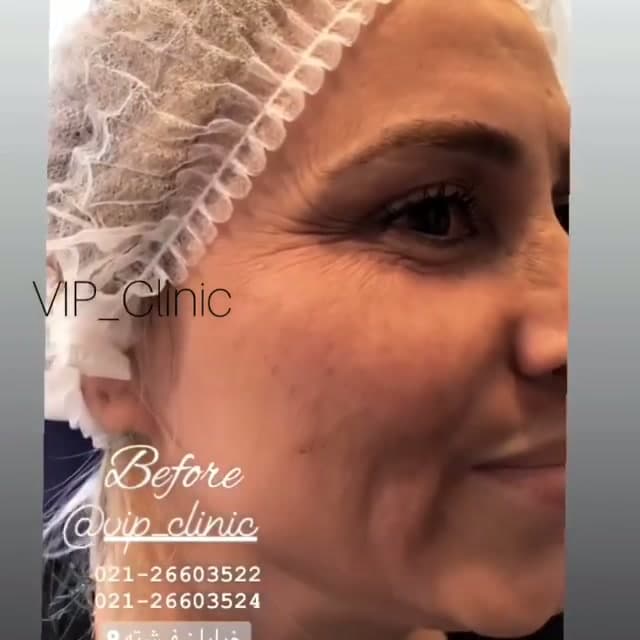 فیلر زیر چشم، گونه و خط اندوه؛ نتیجه طبیعی با محصولات معتبر