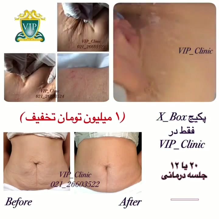 پکیج X_box؛ کاهش ترک‌های بدن با کربوکسی‌تراپی و ایکس ویو