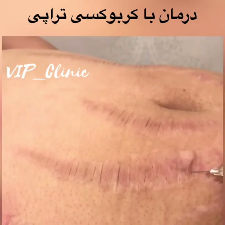 کربوکسی‌تراپی چگونه عمل می‌کند؟ مکانیزم و موارد استفاده