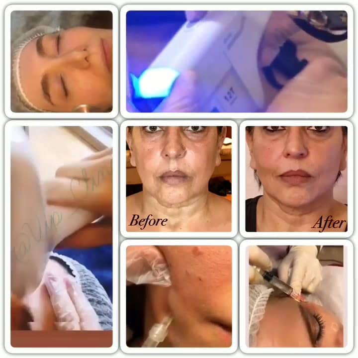 هایفوتراپی؛ پاسخ به سوالات متداول درباره لیفت بدون جراحی