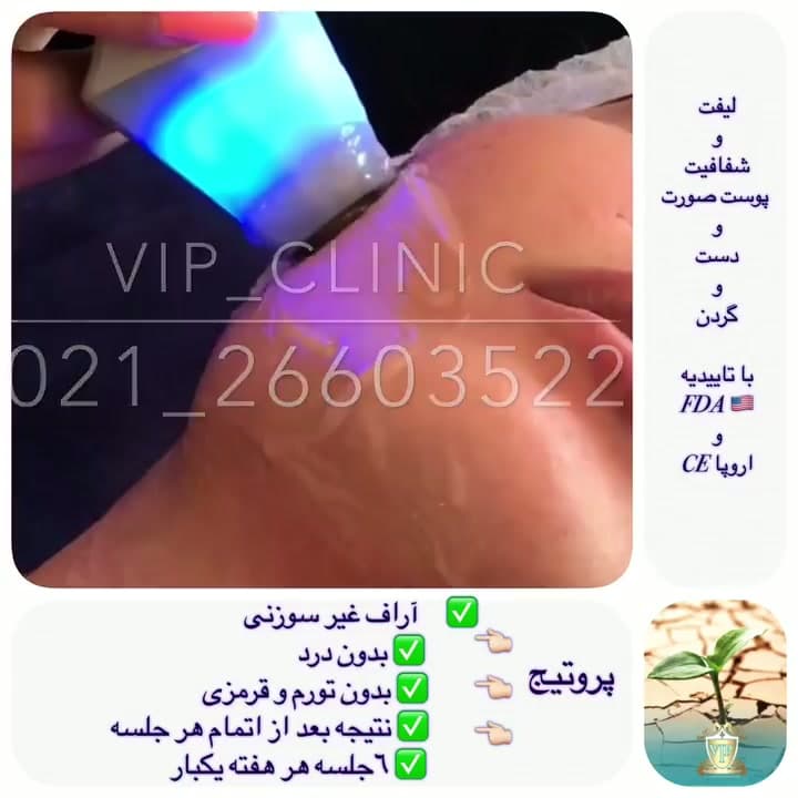 کاهش غبغب و لیفتینگ صورت؛ ترکیب پروتیج و هیدرودرمی کلد پلاسما