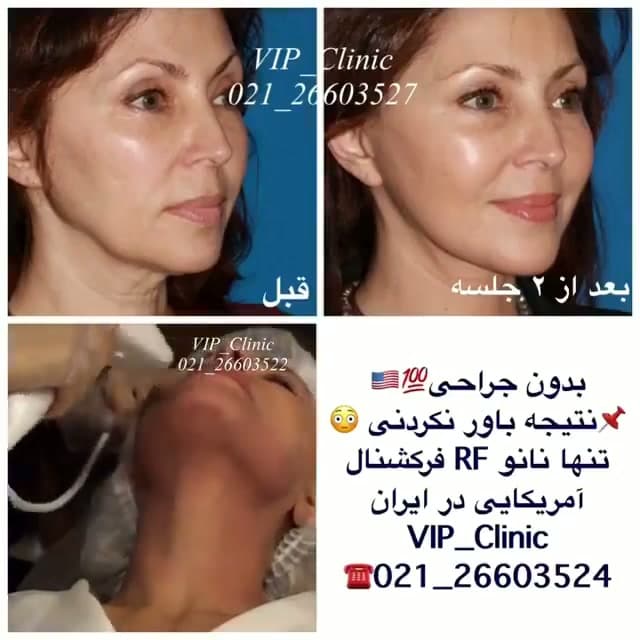 اثرات نانو آراف فرکشنال ونوس ویوا؛ از کلاژن‌سازی تا کاهش اسکار