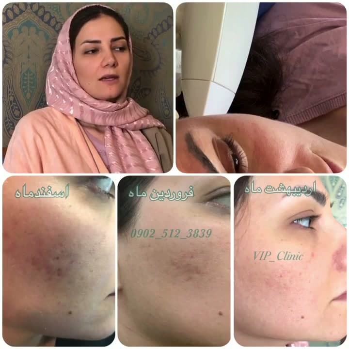جوش‌های ناشی از ماسک و درمان با نانو آراف ونوس ویوا