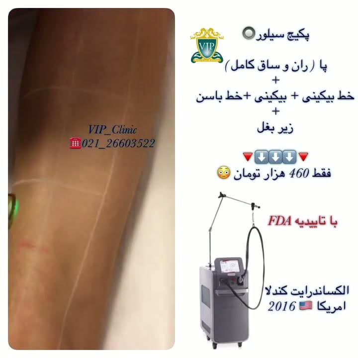لیزر الکساندرایت کندلا؛ سريعترین لیزر دنیا با تاییدیه FDA