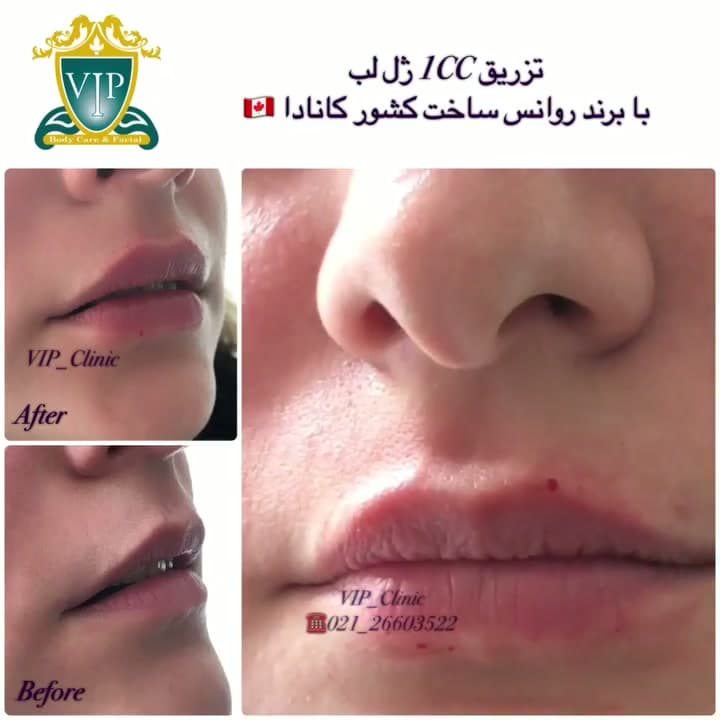 تزریق ۱ سی سی فیلر لب با برند ریونس؛ ماندگاری یک سال