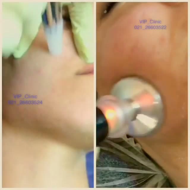 پکیج میکروهیدرودرمی؛ میکرودرم ابریژن و آبرسانی پوست