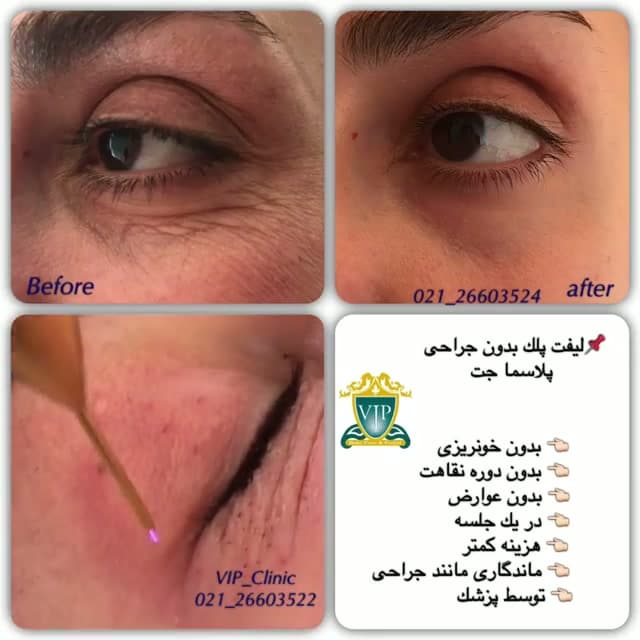 پلاسما جت برای پلک؛ غیرجراحی، بدون فرسایش با گواهی CE