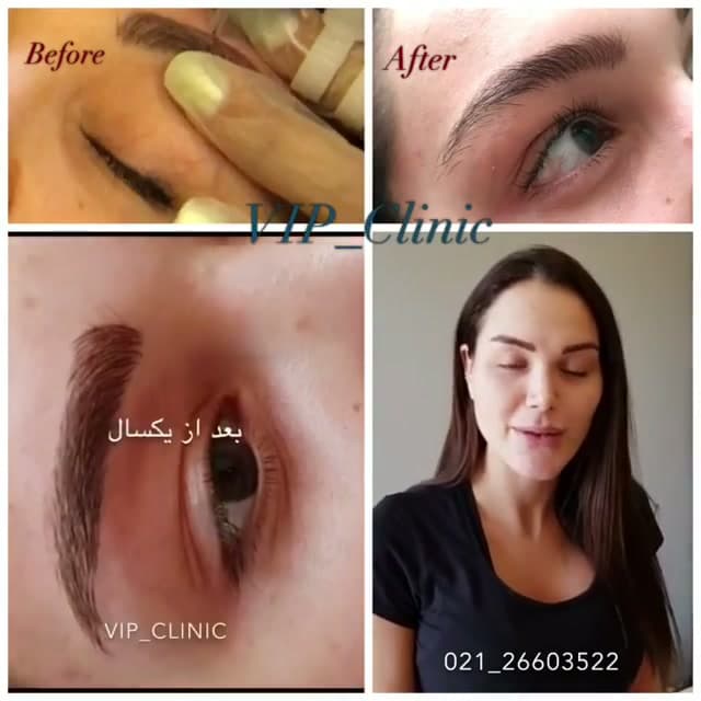 طراحی ابرو، لب و بن مژه؛ رفع تتو قدیمی بدون لیزر