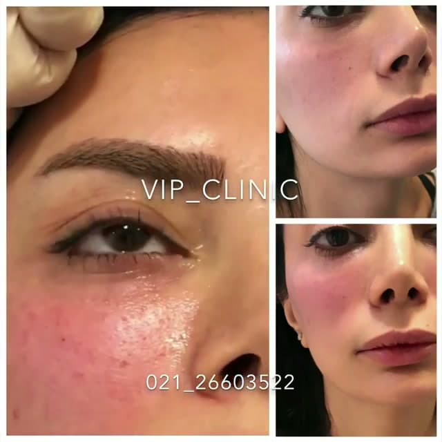 فیلر گونه و زیر چشم؛ فرمدهی طبیعی با محصولات دارای تاییدیه