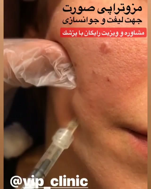 مزوتراپی؛ کاربردهای مهم در زیبایی از لیفتینگ تا کاهش غبغب