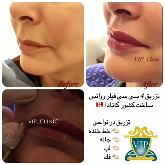 تزریق ۴ سی سی فیلر لب، چانه و خط خنده؛ ماندگاری ۱۲ تا ۱۵ ماه