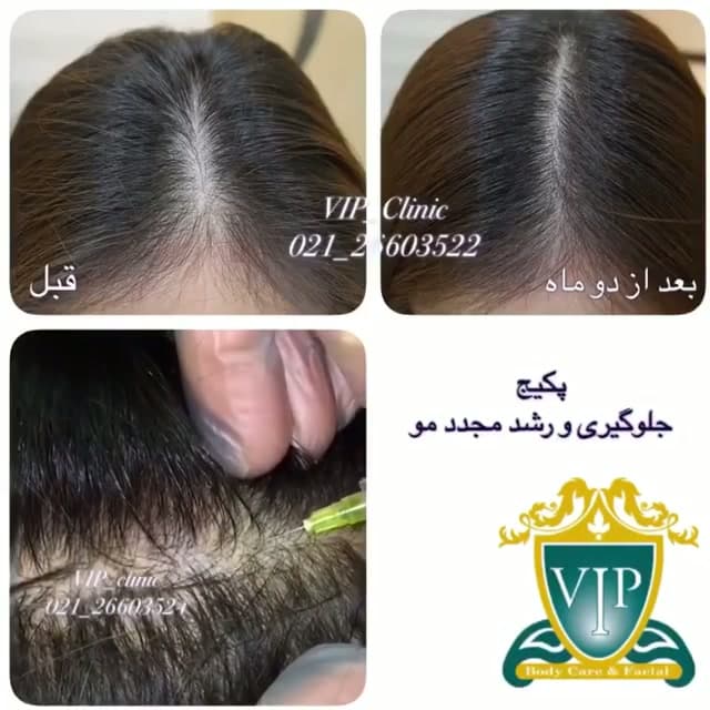 درمان ریزش مو با کربوکسیتراپی و مزوتراپی؛ ۱۰ تا ۲۰ جلسه