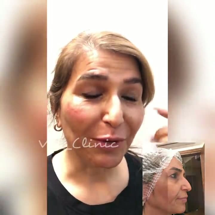 فیلر کانتورینگ صورت؛ نتیجه طبیعی و مطابق سلیقه شما