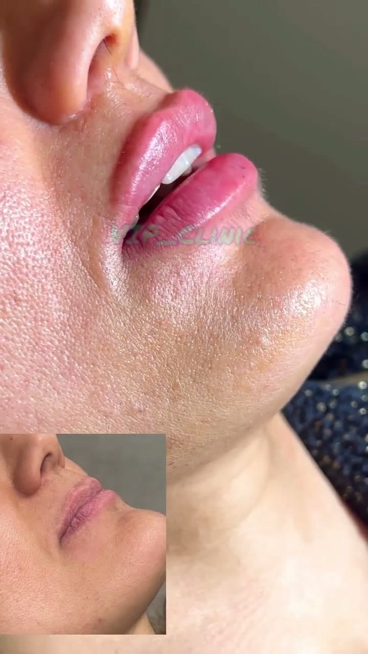 فیلرهای کلینیک؛ تکنیک روسی، شیک و مطابق با فرم صورت